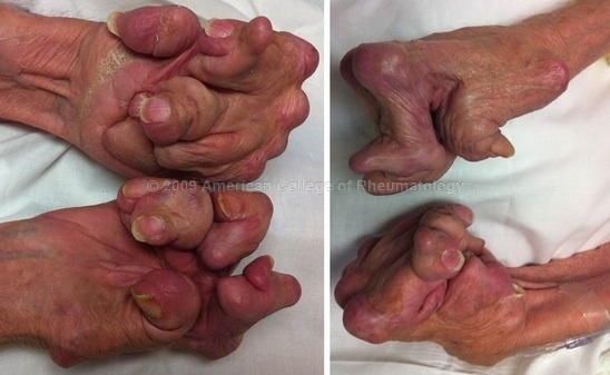 Bệnh viêm khớp dạng thấp (Rheumatoid Arthritis)